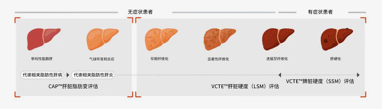 FibroScan? 检查可为各种肝脏疾病的治疗决策提供依据